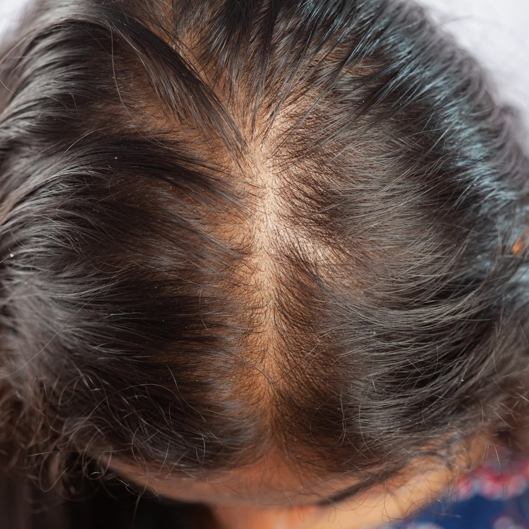 Hair-Loss-Conditions-in-Cambridgeshire