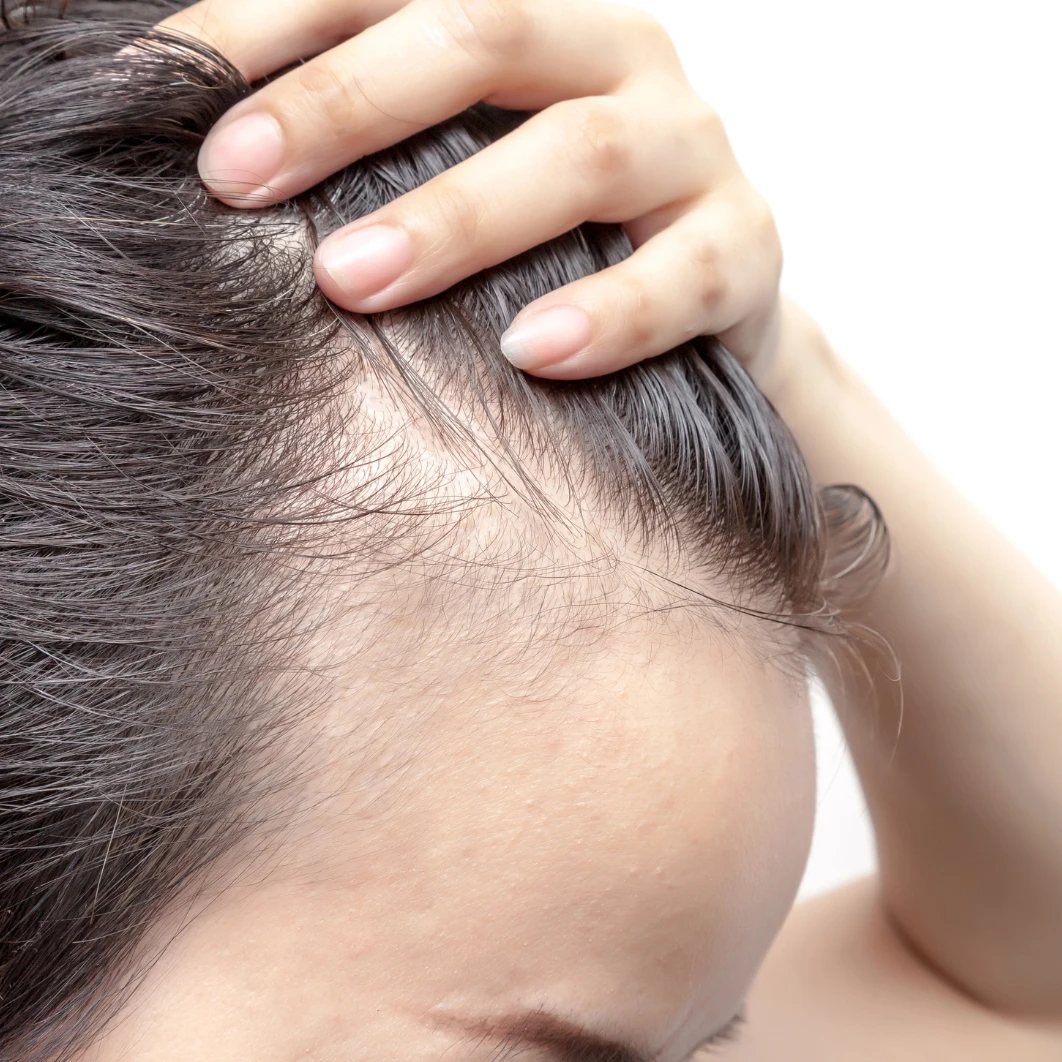 Hair-loss-treatments-in-Cambridgeshire