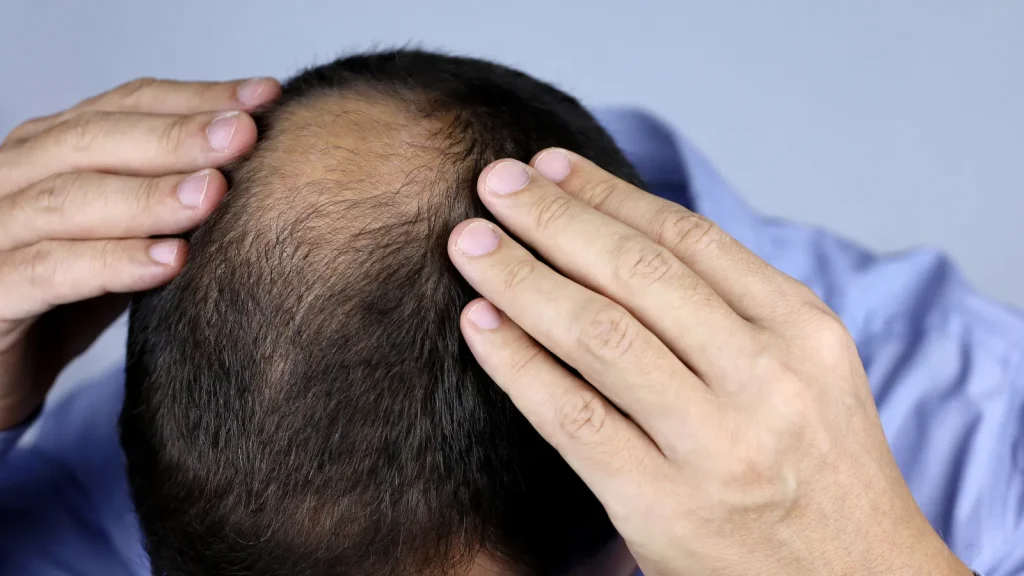 Male Pattern Baldness