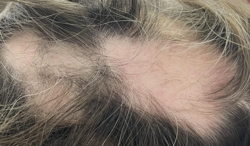 Alopecia areata treatment in Cambridgeshire