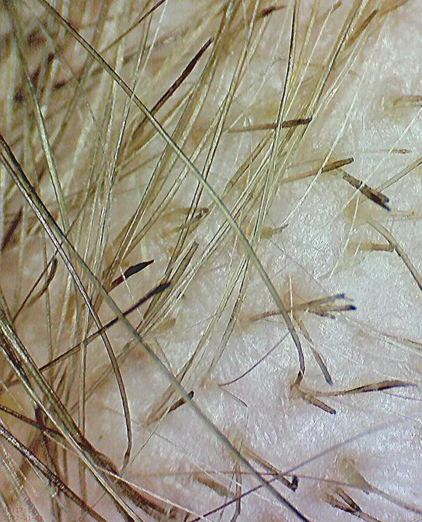 Exclamation mark hairs in Alopecia areata