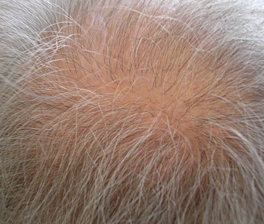 Female pattern hair loss Cambridgeshire