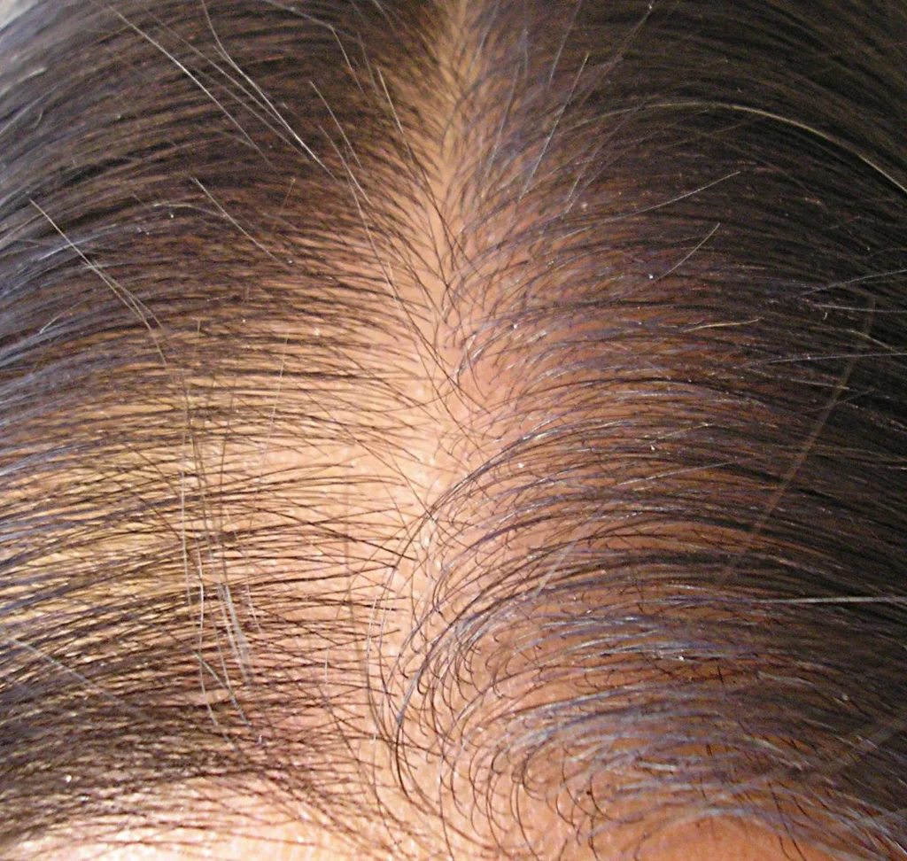 Female pattern hair loss UK