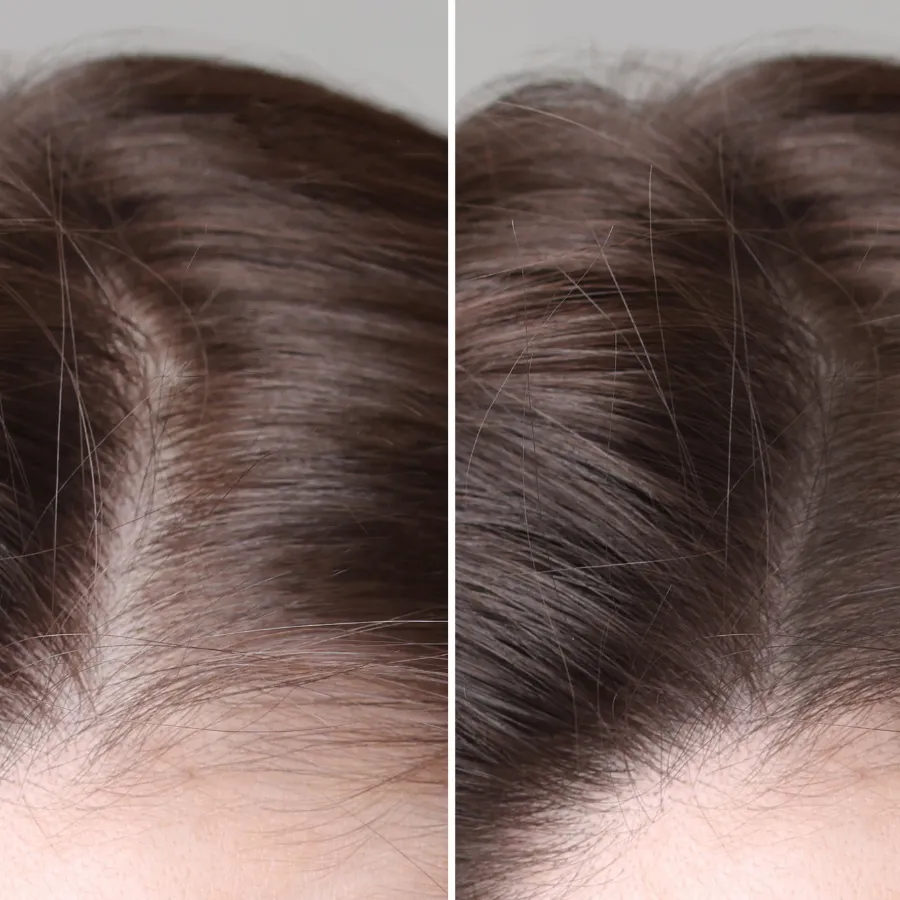 Hair Growth Cycle Explained