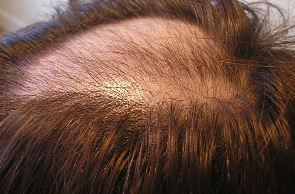 Trichotillomania (hair pulling)